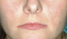 IPL_after-acne-treatment
