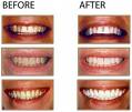 Teeth_Before_and_After